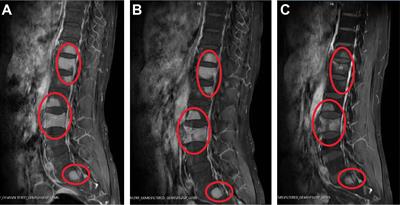 Spinal myeloid sarcoma presenting as initial symptom in acute promyelocytic leukemia with a rare cryptic PLZF::RARα fusion gene: a case report and literature review